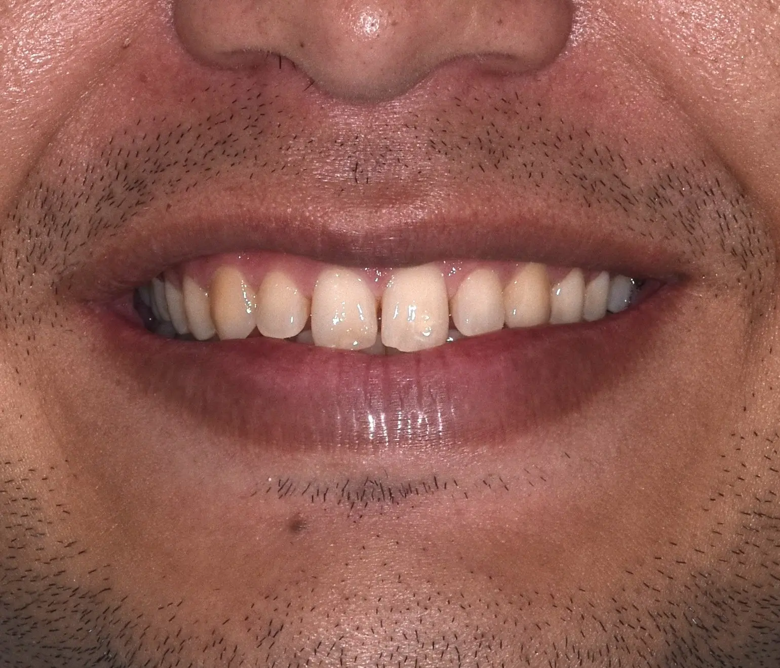 Antes